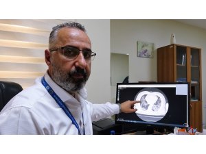 Aşısız hastaların akciğer tomografisini paylaşarak uyardı