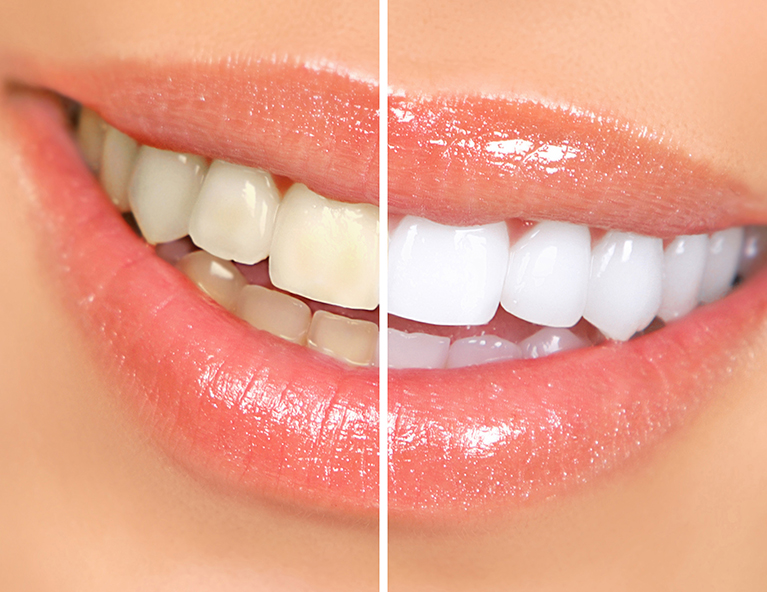 Diş beyazlatmada en etkili yöntemler nelerdir?