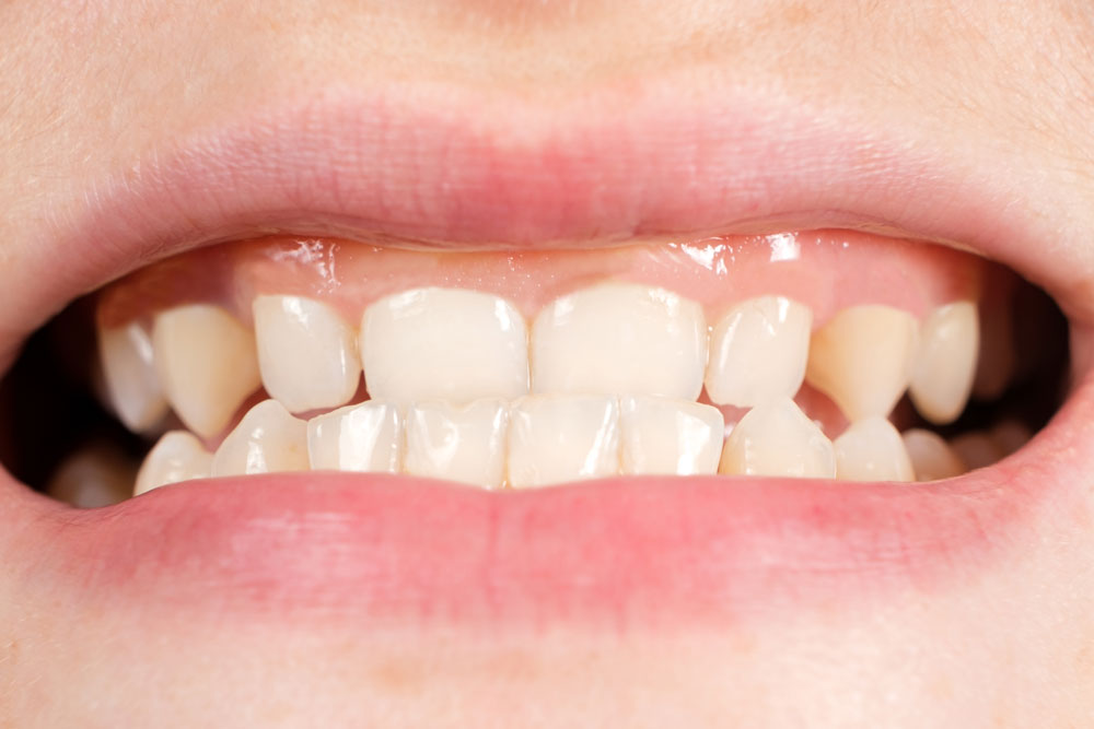 Diş gıcırdamasından nasıl kurtuluruz?