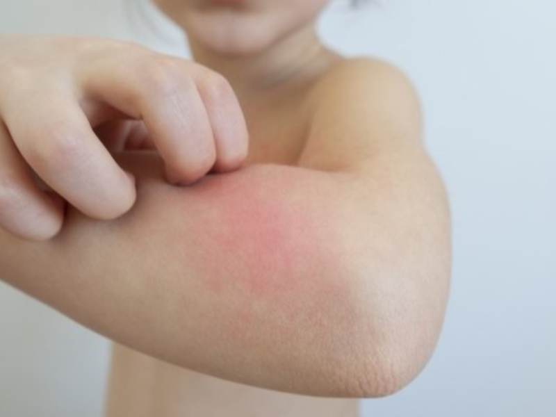 Son 10 yılın alerji salgını: Besin alerjileri, giderek artıyor