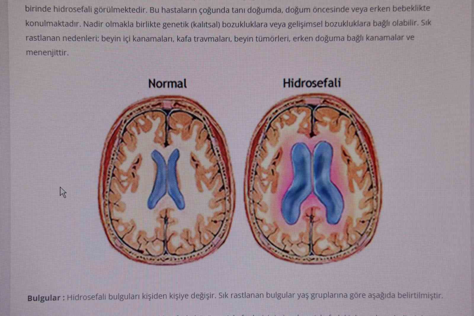 ’Hidrosefali' hastalığına dikkat