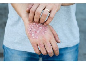 “Soğuk hava psoriasis’i şiddetlendiriyor”