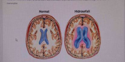 ’Hidrosefali' hastalığına dikkat